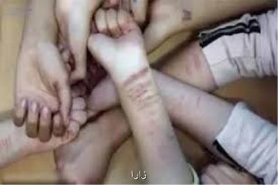 صدمه عمدی به خود یكی از رفتارهای پر خطر دانشجویان